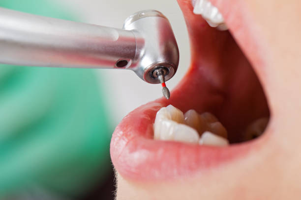 Best Urgent Care for Lost Fillings or Crowns in Stow, OH